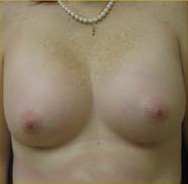 Breast Augmentation Case 3463 After Photo Breast Augmentation