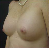 Breast Augmentation Case 3463 After Photo Breast Augmentation