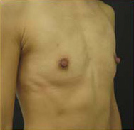 Breast Augmentation Case 3469 Before Photo Breast Augmentation