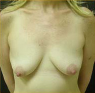 Breast Augmentation Case 3475 Before Photo Breast Augmentation