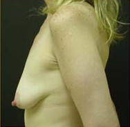 Breast Augmentation Case 3475 Before Photo Breast Augmentation