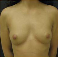 Breast Augmentation Case 3481 Before Photo Breast Augmentation