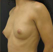 Breast Augmentation Case 3481 Before Photo Breast Augmentation