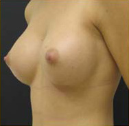 Breast Augmentation Case 3481 After Photo Breast Augmentation
