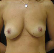 Breast Augmentation Case 3487 Before Photo Breast Augmentation