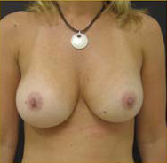 Breast Augmentation Case 3487 After Photo Breast Augmentation