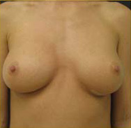 Breast Augmentation