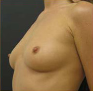 Breast Augmentation