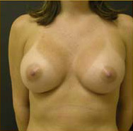 Breast Augmentation Case 3499 After Photo Breast Augmentation