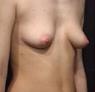 Breast Augmentation Case 3505 Before Photo Breast Augmentation