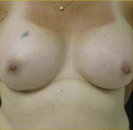 Breast Augmentation Case 3511 After Photo Breast Augmentation