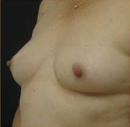 Breast Augmentation Case 3511 Before Photo Breast Augmentation