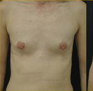 Breast Augmentation Case 3517 Before Photo Breast Augmentation