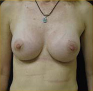 Breast Augmentation Case 3517 After Photo Breast Augmentation