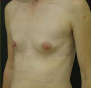 Breast Augmentation Case 3517 Before Photo Breast Augmentation