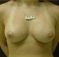 Breast Augmentation Case 3523 After Photo Breast Augmentation