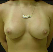 Breast Augmentation