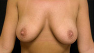 Breast Augmentation Case 3529 Before Photo Breast Augmentation