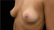 Breast Augmentation Case 3535 Before Photo Breast Augmentation