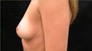 Breast Augmentation Case 3535 Before Photo Breast Augmentation