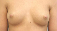 Breast Augmentation