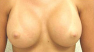 Breast Augmentation Case 3541 After Photo Breast Augmentation