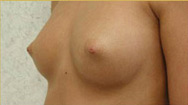 Breast Augmentation Case 3541 Before Photo Breast Augmentation