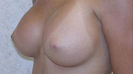 Breast Augmentation Case 3541 After Photo Breast Augmentation