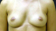 Breast Augmentation Case 3547 Before Photo Breast Augmentation