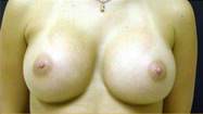 Breast Augmentation Case 3547 After Photo Breast Augmentation