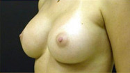 Breast Augmentation Case 3547 After Photo Breast Augmentation