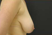 Breast Augmentation