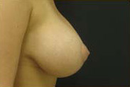 Breast Augmentation Case 3559 After Photo Breast Augmentation