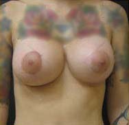 Breast Augmentation Case 3565 After Photo Breast Augmentation