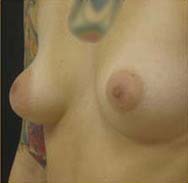 Breast Augmentation