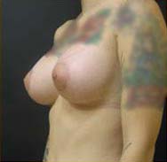 Breast Augmentation