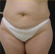 Abdominoplasty