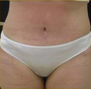 Abdominoplasty