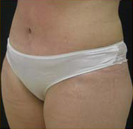 Abdominoplasty