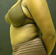 Abdominoplasty