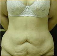 Abdominoplasty