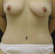 Abdominoplasty