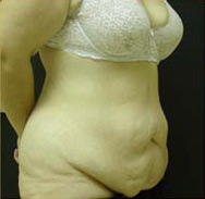 Abdominoplasty