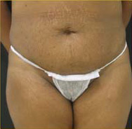 Abdominoplasty