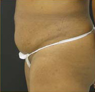 Abdominoplasty