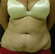 Abdominoplasty