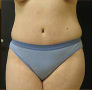 Abdominoplasty