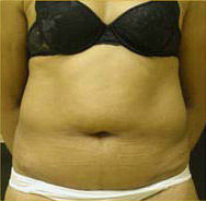 Abdominoplasty