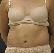 Abdominoplasty