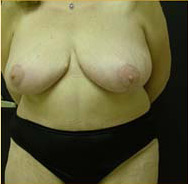 Abdominoplasty